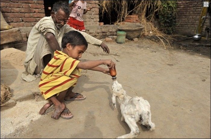 Garoto indiano com gêmeo parasita faz cirurgia