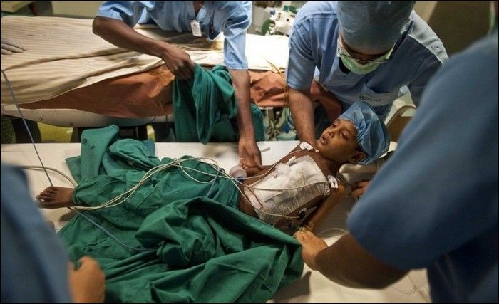 Garoto indiano com gmeo parasita faz cirurgia 10