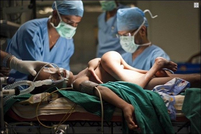 Garoto indiano com gmeo parasita faz cirurgia 11