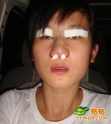 Cirurgia de ocidentalizao dos olhos vira mania na China