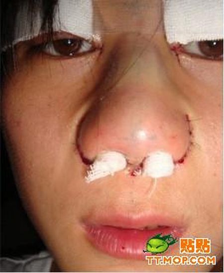 Cirurgia de ocidentalização dos olhos vira mania na China