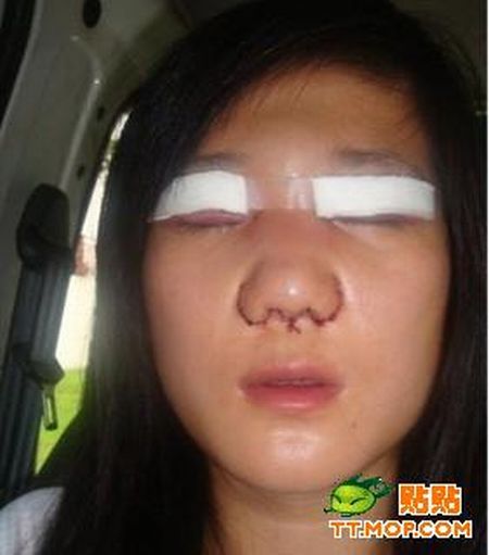 Cirurgia de ocidentalizao dos olhos vira mania na China