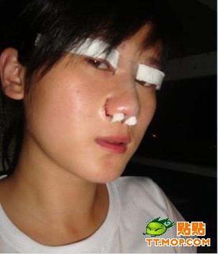 Cirurgia de ocidentalizao dos olhos vira mania na China