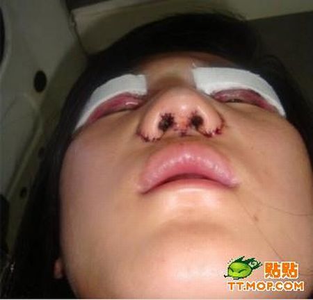 Cirurgia de ocidentalizao dos olhos vira mania na China