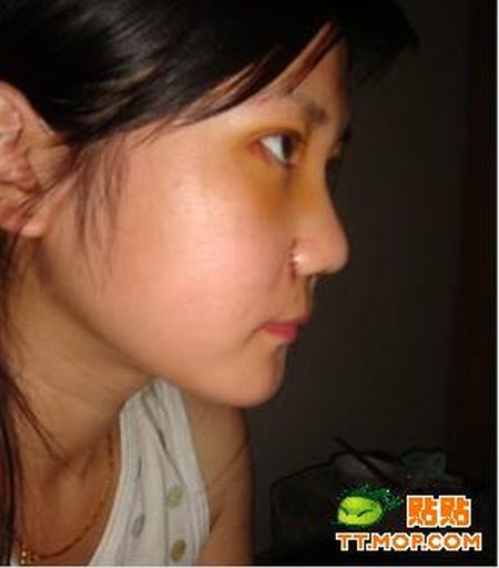 Cirurgia de ocidentalizao dos olhos vira mania na China