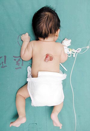 Nasce beb com um segundo pnis nas costas na China