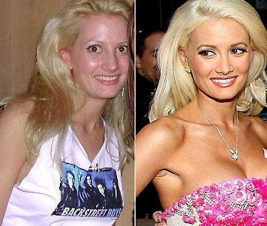 Famosos antes e depois da cirurgia plástica