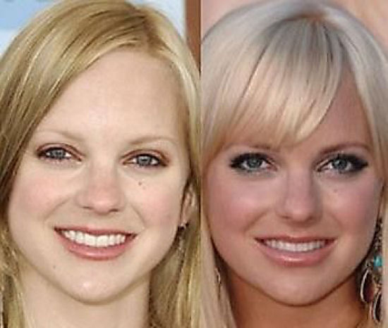 Celebridades antes e depois da cirurgia plástica - MDig