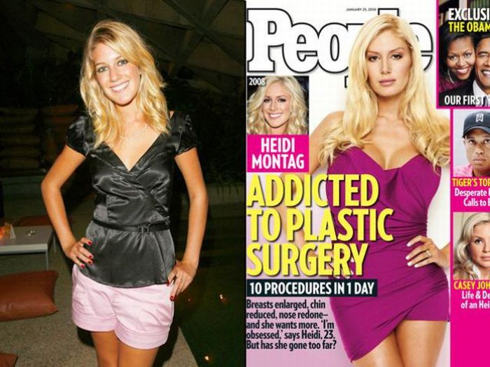 Celebridades antes e depois da cirurgia plástica