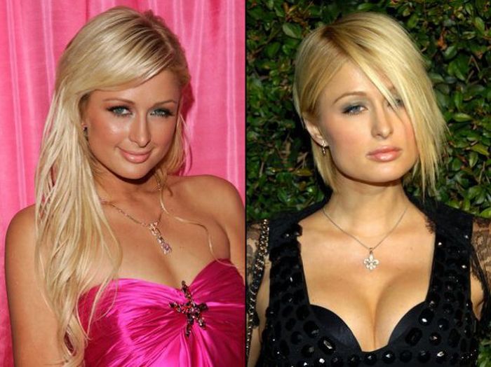 Celebridades antes e depois da cirurgia plástica