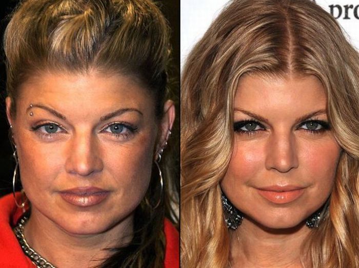 Celebridades antes e depois da cirurgia plástica