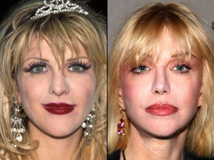 Celebridades antes e depois da cirurgia plástica