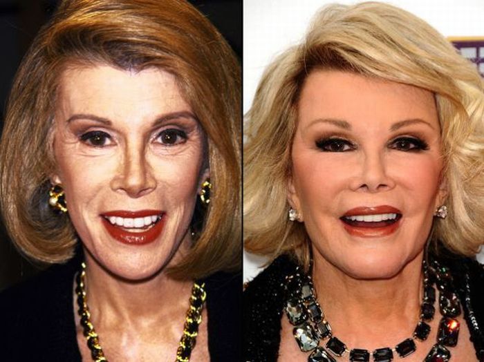 Celebridades antes e depois da cirurgia plástica