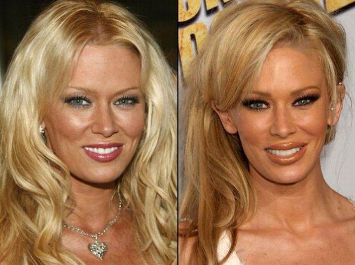 Celebridades antes e depois da cirurgia plástica