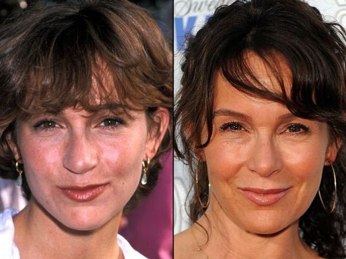 Celebridades antes e depois da cirurgia plástica