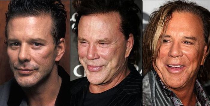 Celebridades antes e depois da cirurgia plástica