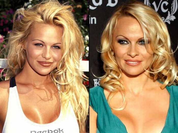 Celebridades antes e depois da cirurgia plástica