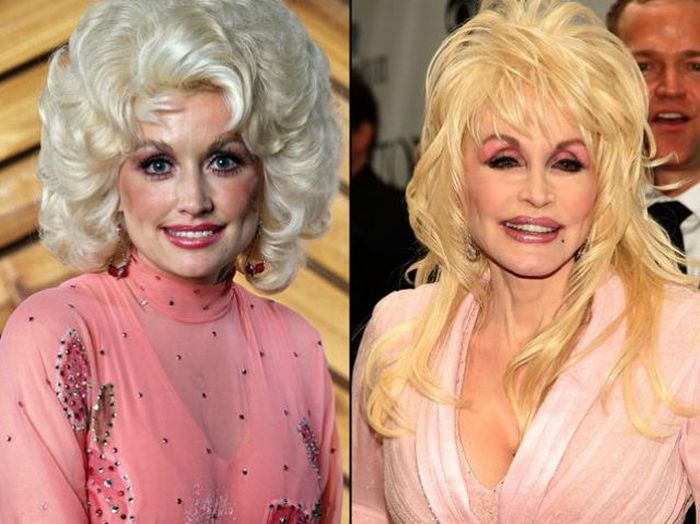 Celebridades antes e depois da cirurgia plástica