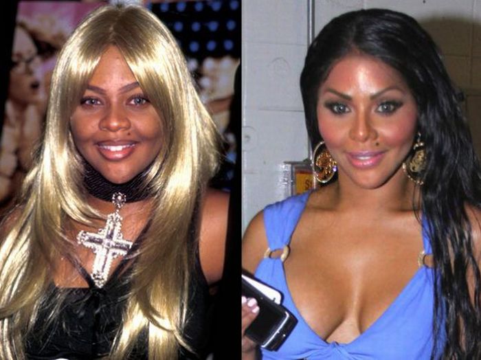 Celebridades antes e depois da cirurgia plástica