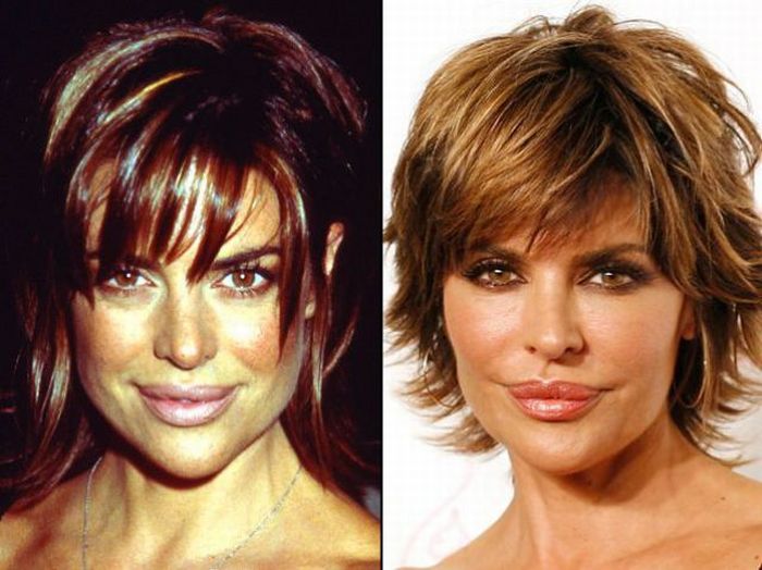 Celebridades antes e depois da cirurgia plástica