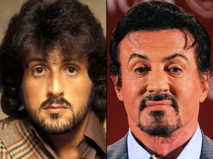 Celebridades antes e depois da cirurgia plástica