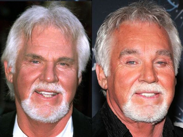 Celebridades antes e depois da cirurgia plástica
