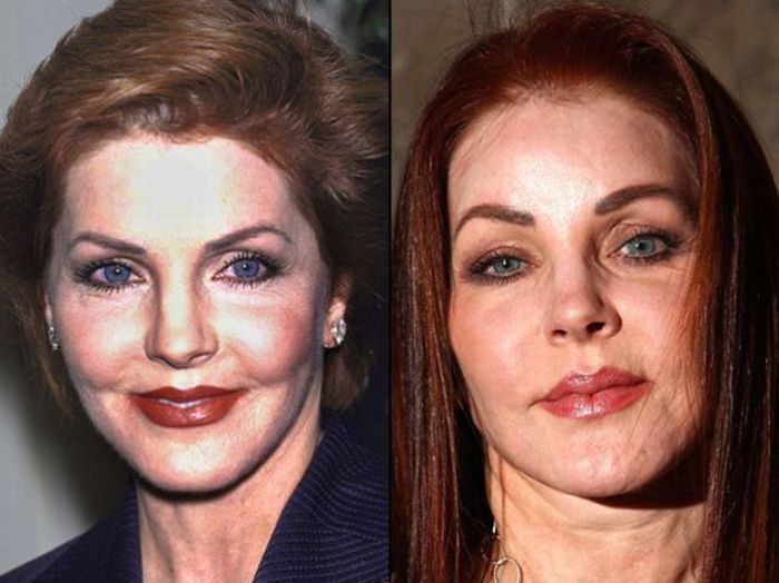 Celebridades antes e depois da cirurgia plástica