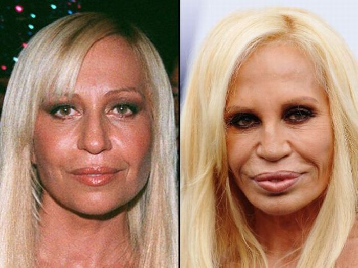 Celebridades antes e depois da cirurgia plástica - MDig