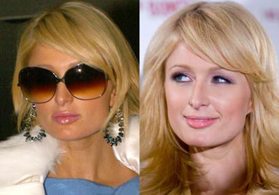 Antes e depois de famosas com silicone nos lábios