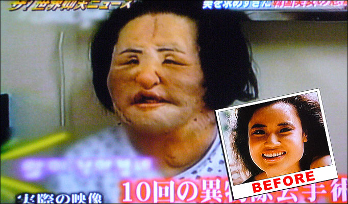 Coreana deforma o rosto por injetar azeite de cozinha na face