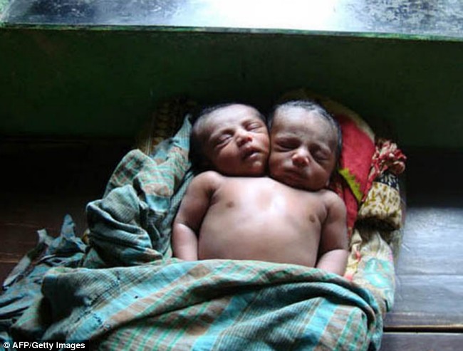 Nasce beb com duas cabeas em Bangladesh
