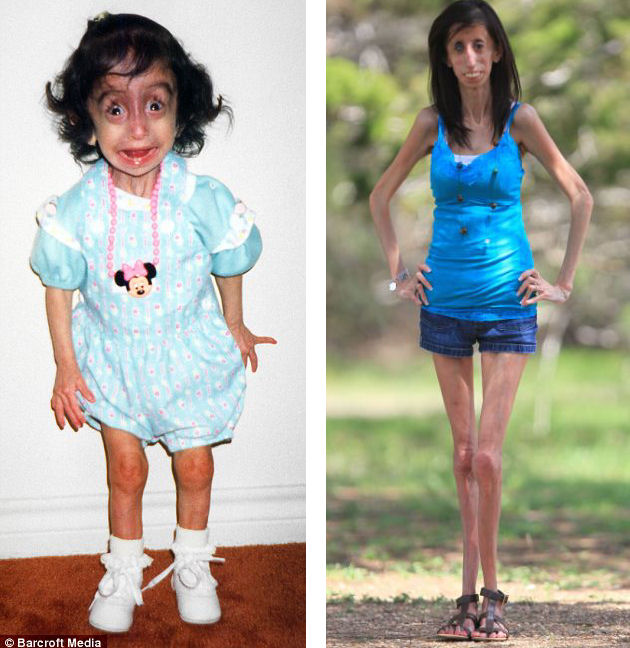 Lizzie Velasquez