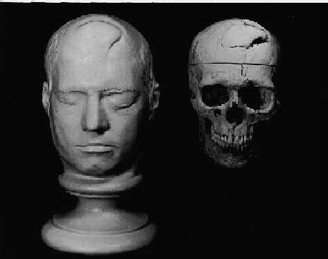 Phineas Gage - O homem que levou ferro