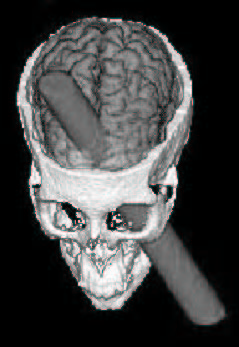 Phineas Gage - O homem que levou ferro