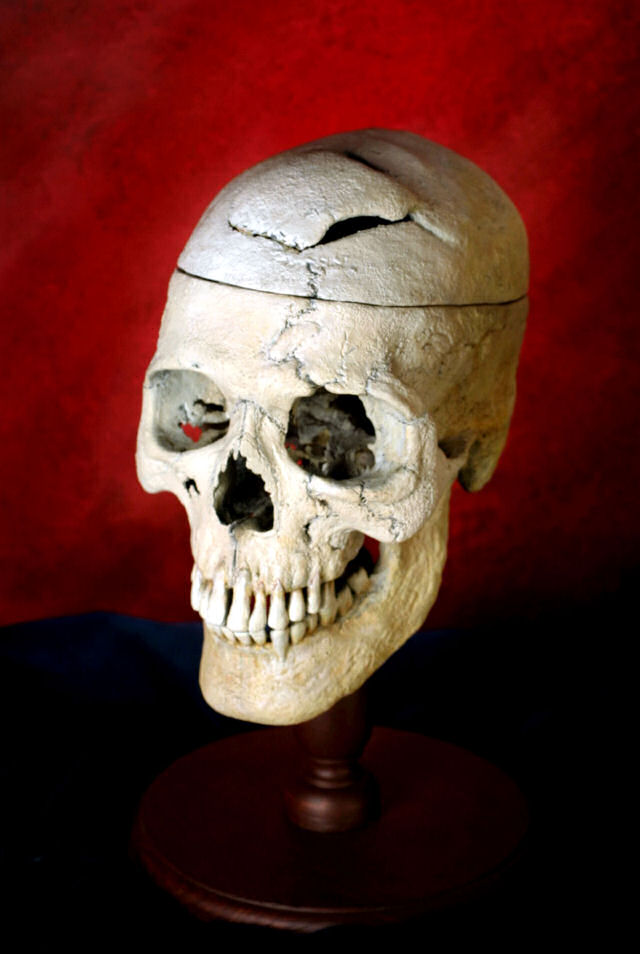 Phineas Gage - O homem que levou ferro