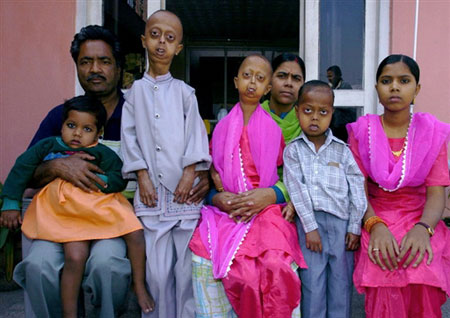 Uma familia com progeria