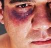 olho-roxo-3.jpg olho-roxo-3.jpg
